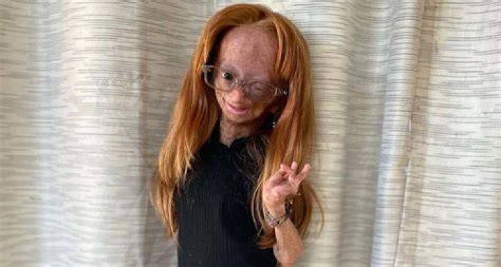 Adalia Rose Williams A girl who used social media to live Proven