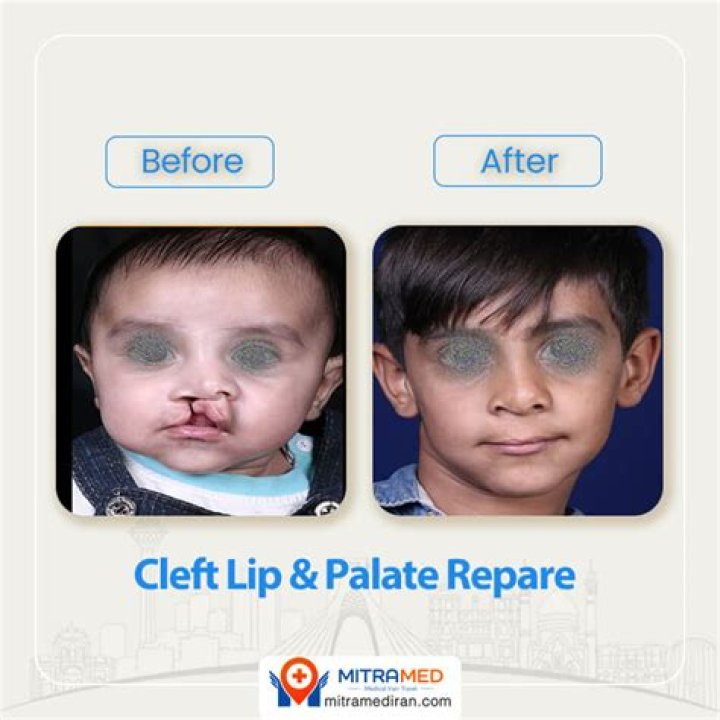 Cleft Lip and Palate Repair Johns Hopkins Facial Plastic and
