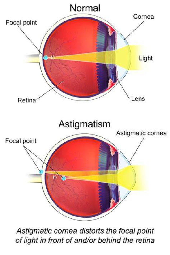 People Realize They Have Astigmatism Thanks To A Viral Comparison Photo