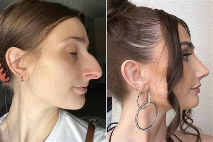 Sssniperwolf’s Nose Job Before And After Photos Justinboey