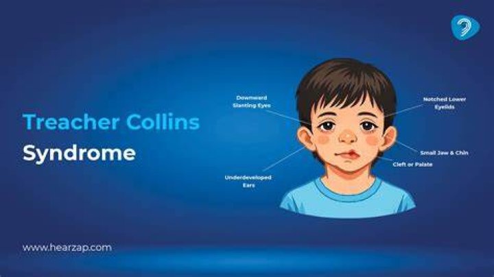 Treacher Collins syndrome causes, signs, symptoms, diagnosis & treatment