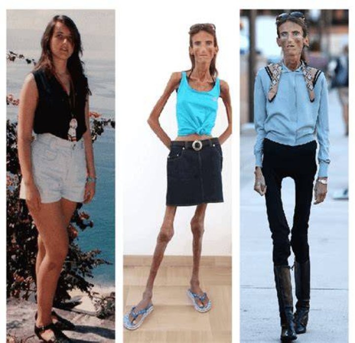 Who is the skinniest person in the world? A list of the top 10